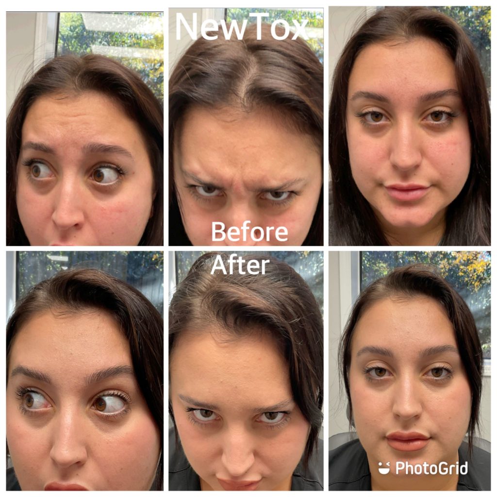 new tox before after