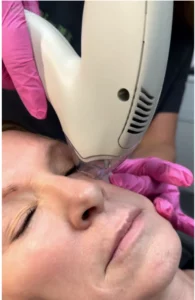 Tixel Skin Rejuvenation in Anderson & Greenville SC