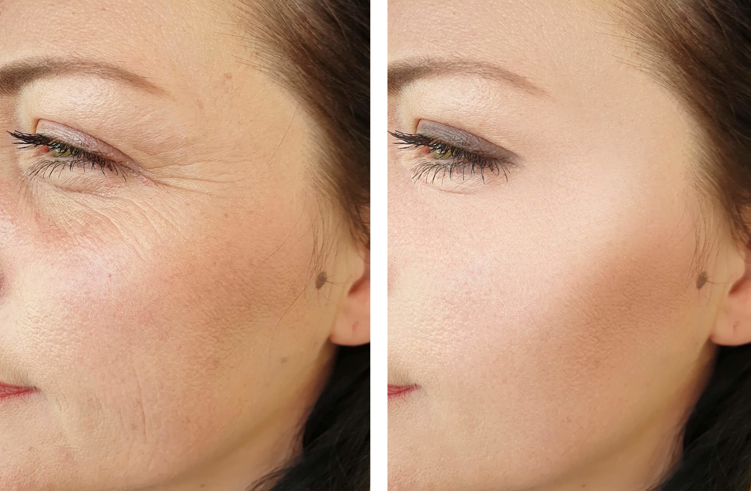 Anti Aging Treatment Before and After Photos | Bare N Beautiful in Anderson, SC
