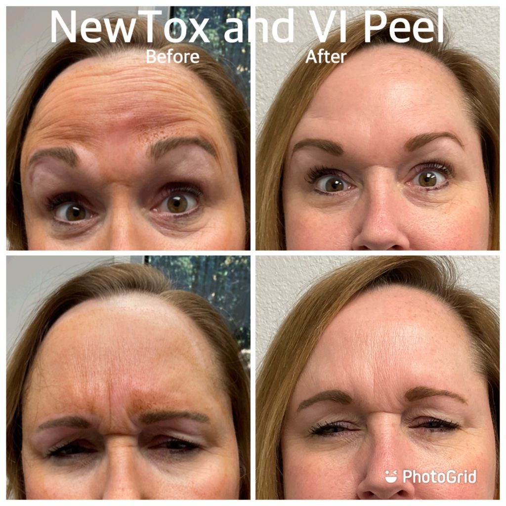 new tox and iv peel before after