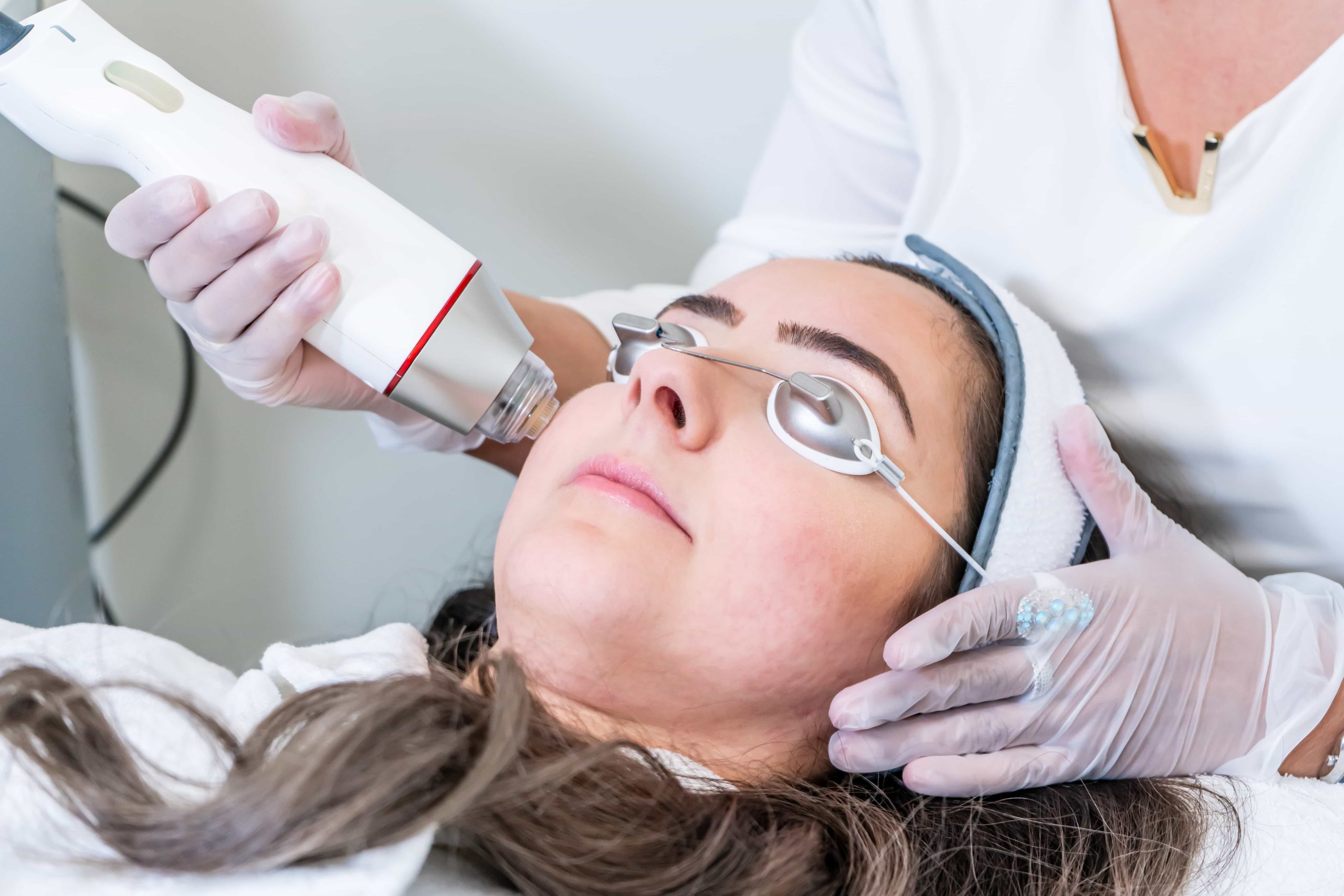 5 Benefits Of RF Microneedling You Should Know
